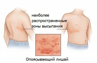 Причина, вызывающая опоясывающий герпес, существует только одна - это попадание вируса в организм