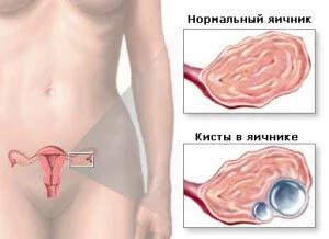 Поликистоз яичников - одна из причин задержки месячных